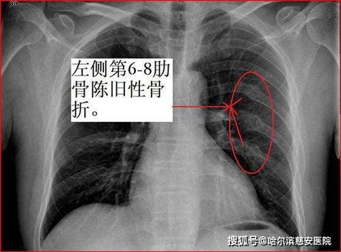 女子被老头乐压到致肋骨骨折