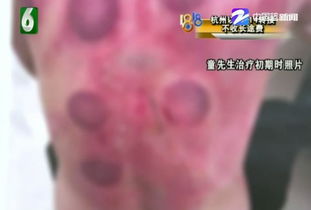男子拔罐时着了火 老板:关我什么事 男子拔罐时着了火 老板:关我什么事