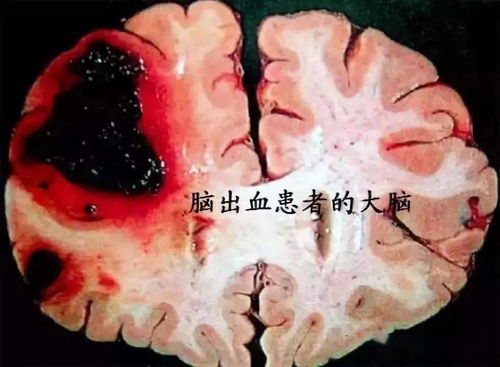 女生突发脑出血 症状是不会说英语(女生突发脑出血与语言障碍,不会说英语的紧急症状) 女生突发脑出血 症状是不会说英语(女生突发脑出血与语言障碍,不会说英语的紧急症状)