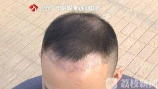 女子因发量太多剃掉五分之四头发(女子因发量太多决定剃掉五分之四的头发,一次关于自我接纳与改变的冒险之旅) 女子因发量太多剃掉五分之四头发(女子因发量太多决定剃掉五分之四的头发,一次关于自我接纳与改变的冒险之旅)