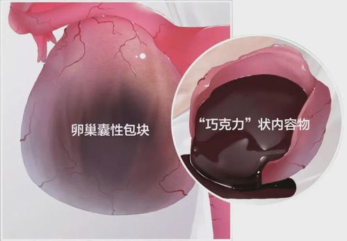 25岁女生痛经十几年决定停经(一位25岁女生长达十几年的痛经经历与她的停经决定) 25岁女生痛经十几年决定停经(一位25岁女生长达十几年的痛经经历与她的停经决定)
