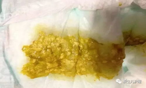 产检发现胎儿在妈妈腹中拉肚子 产检发现胎儿在妈妈腹中拉肚子