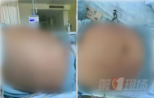 13岁女孩体重超220斤确诊多囊